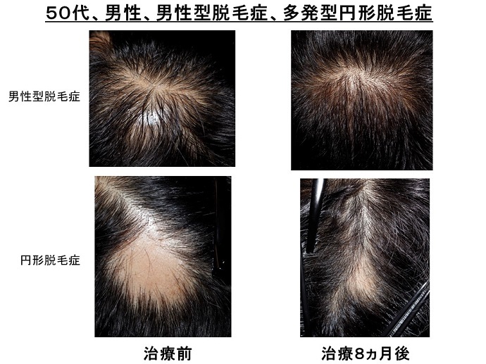 円形脱毛症　病院